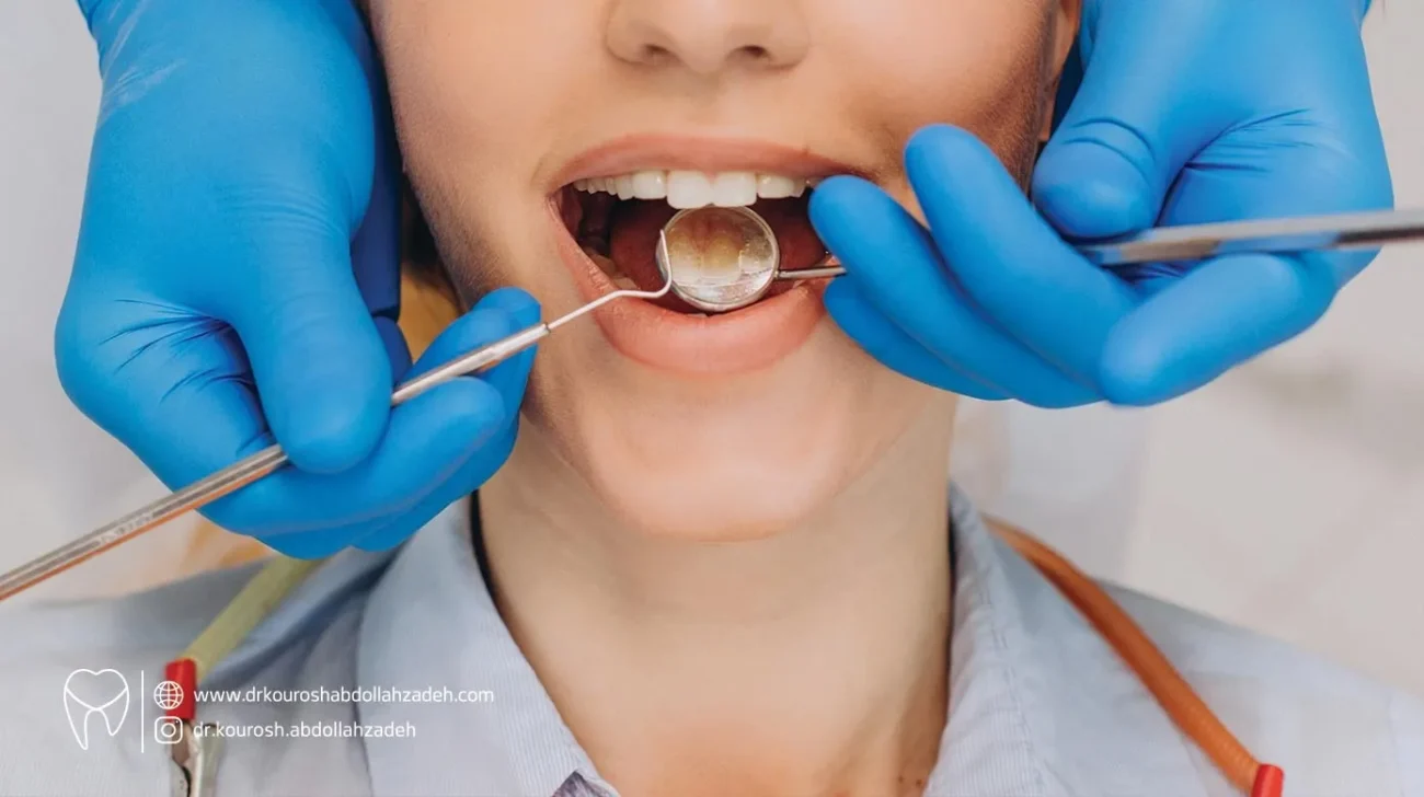 عصب کشی دندان